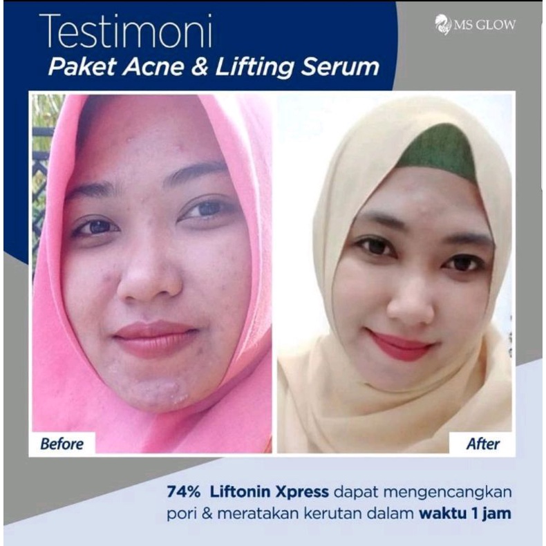 Paket Acne + Serum Lifting MS GLOW