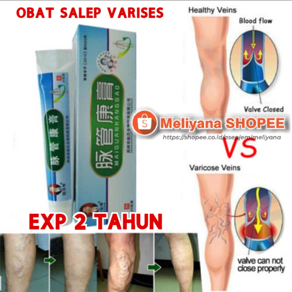 Salep Varises Herbal Ampuh Varicose Veins Treatment