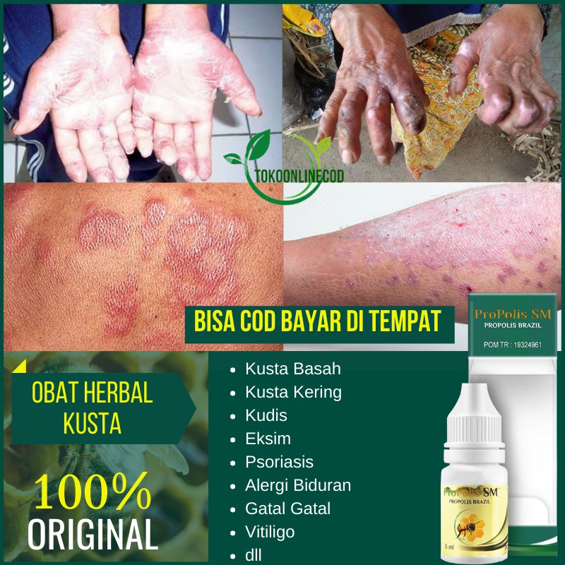 Obat Kusta - Kusta Basah - Kusta Kering - Kusta Eksim - Lepra - Herbal Alami di Kaki dan Wajah