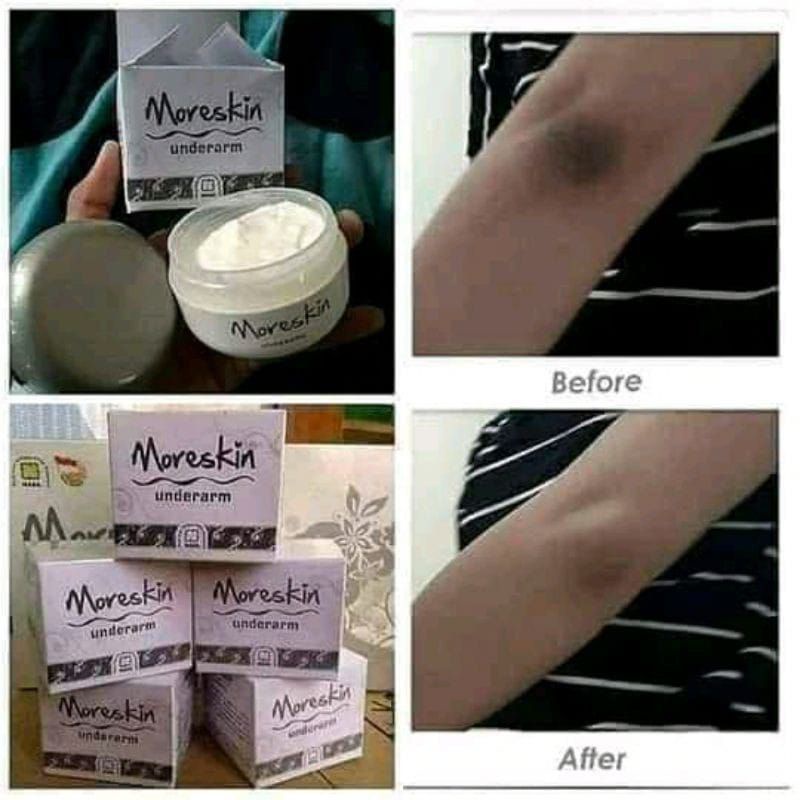 MORESKIN UNDERARM NASA - CREAM LUKA BAKAR - CREAM LUKA KORENG - CREAM KETIAK DAN SELANGKANGAN - CREA