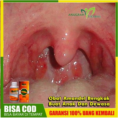 Obat Amandel - Radang Amandel - Amandel Bengkak Buat Anak Dan Dewasa | QnC Jelly Gamat