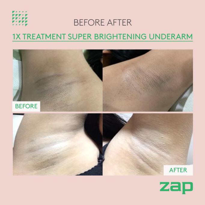 Super Brightening Underarm Shopee Indonesia