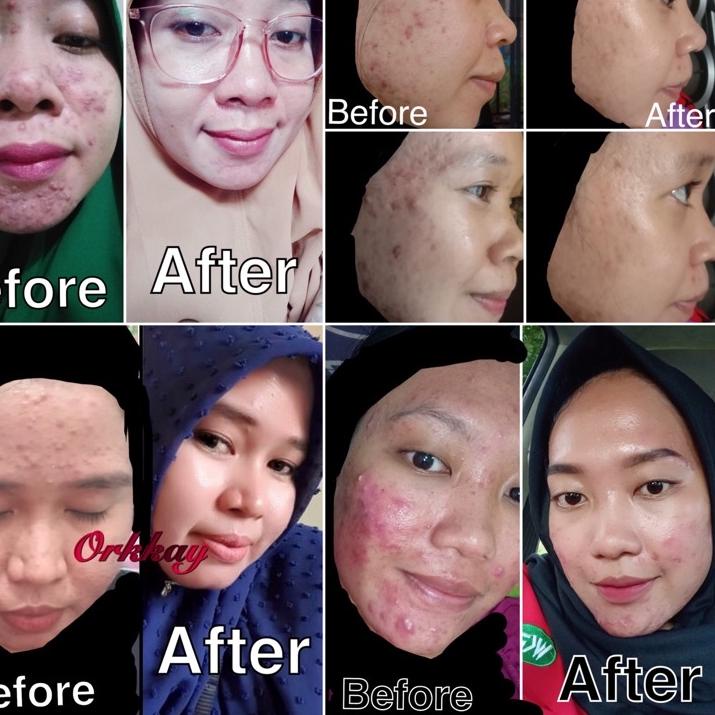 [PRODUK 6SNTY] Paket Premium Acne Glow & Paket Premium White Glow Orkkay Skincare J0J