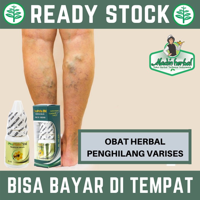 Obat Penghilang Varises Premium Varises Esofagus Urat Menonjol Propolis Brazil Sm Propolis Sm Shopee Indonesia