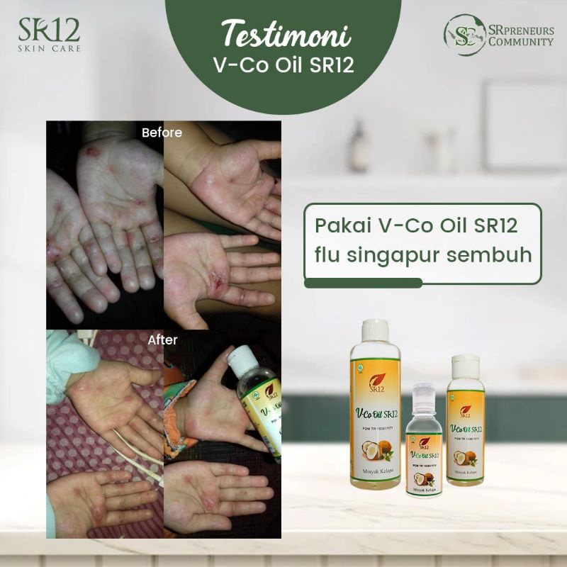 VCO Bayi - Obat Gatal Gatal - Biang Keringat - Ruam Popok Bayi - Obat Ruam Merah - VICO SR12 Minyak Kelapa 100% Herbal Aman BPOM
