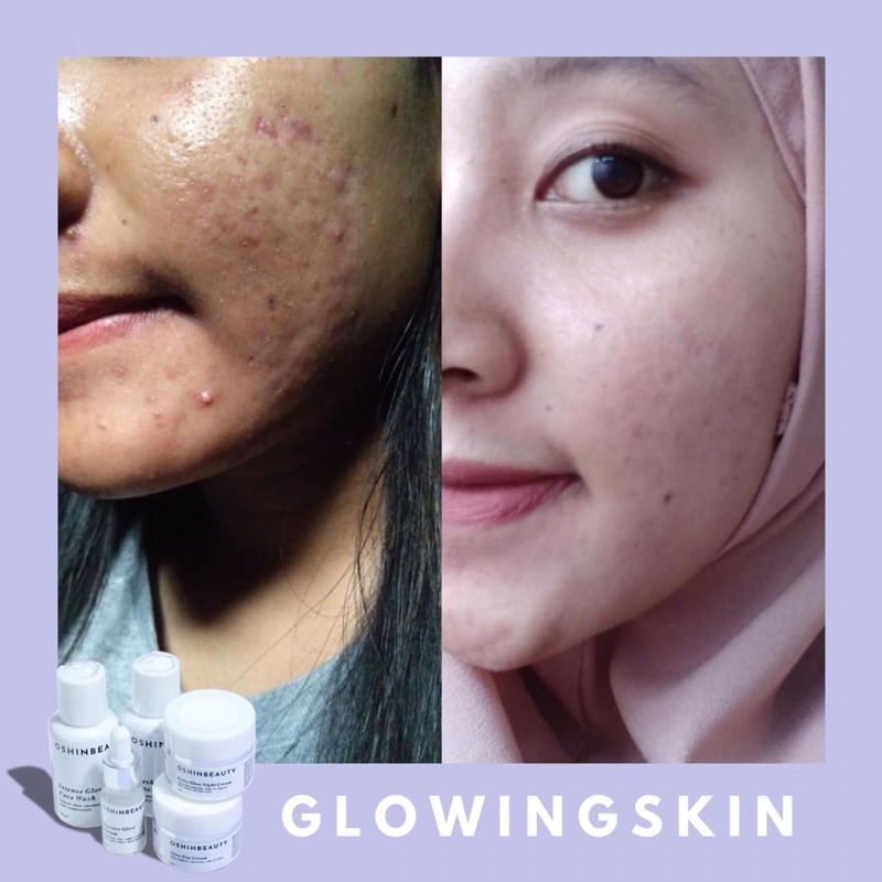 (OSHINBEAUTY) Paket Skincare Glow dan Acne Series Complete BPOM [Free Gift/Bonus]-6