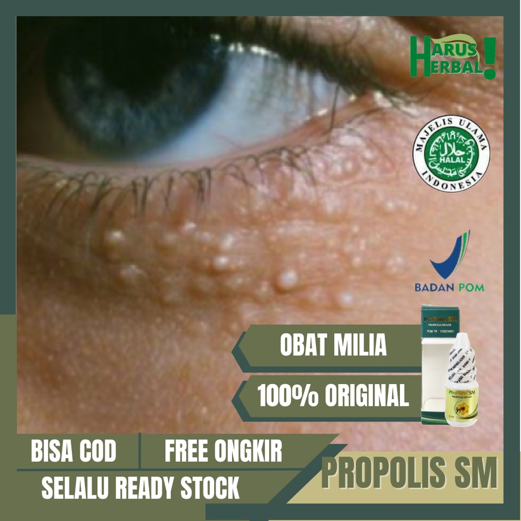 Obat Milia Alami, Obat Milia Di Bawah Mata, Obat Menghilangkan Milia, Obat Beruntusan Di Wajah, Obat