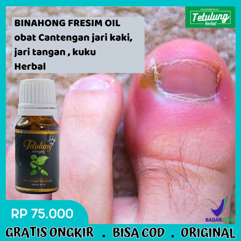 Obat Cantengan Jempol Kaki Luka Bengkak Bernanah - Fresim Binahong Oil - Obat Cantengan Kuku - Obat 