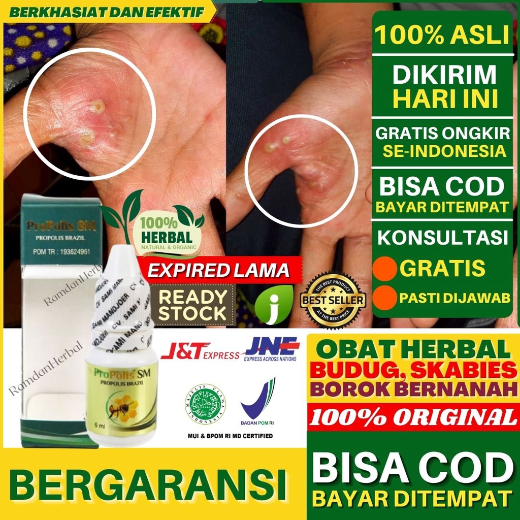 Jual Obat Budug Bernanah Nyeri Skabies Budug Santri Gudig Gudik Budug ...