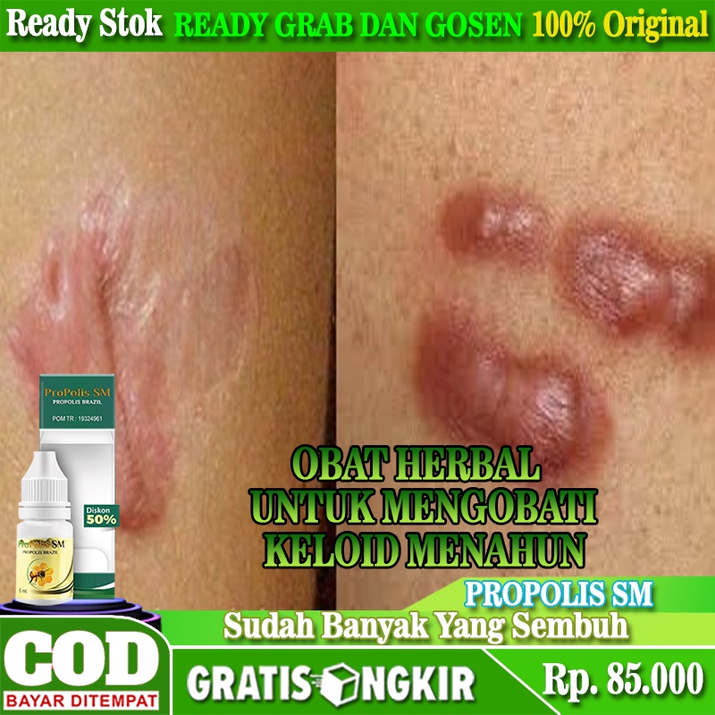 Jual Obat Keloid Menahun , Obat Keloid Menonjol Menahun, Obat Daging