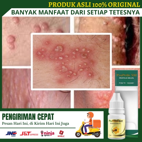 Obat gatal di penis