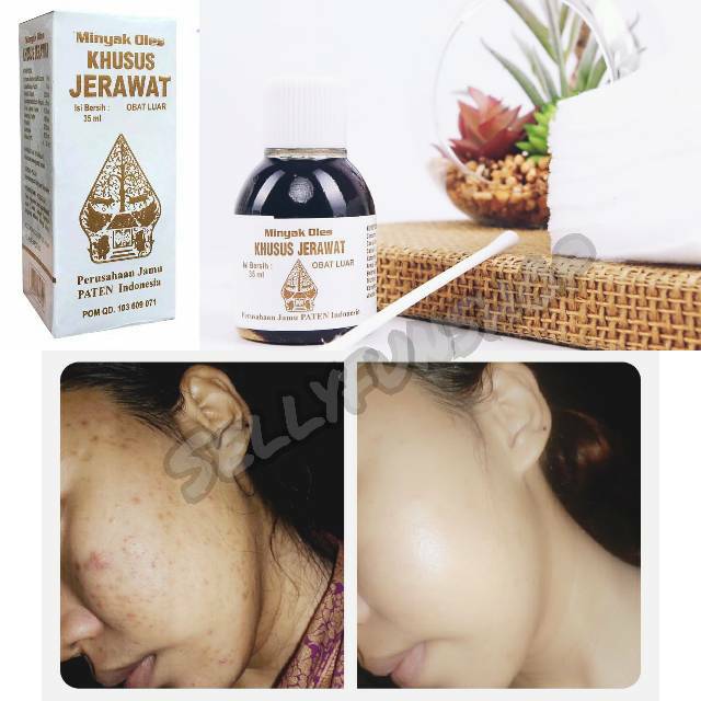 OBAT JERAWAT AMPUH BPOM ALAMI PERMANEN TETES TOTOL CAP WAYANG ORIGINAL ACNES