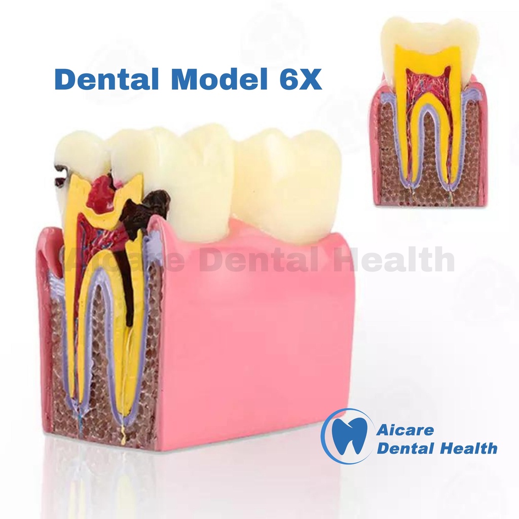 Dental Model 6X Tooth Decay 2 Side - Model Gigi Karies 6X 2 Sisi