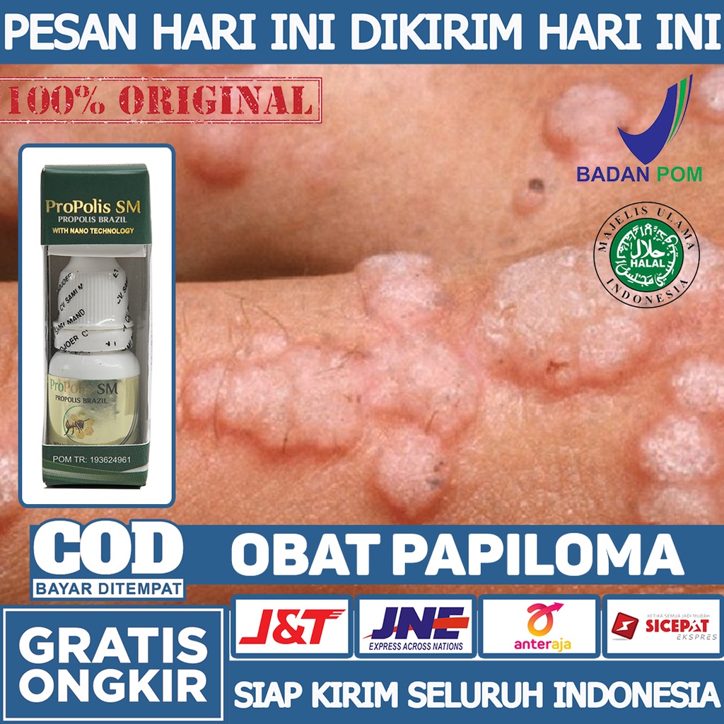 Obat Papiloma - Penghilang Papiloma - Papiloma di Kelopak Mata - Papiloma di Wajah - Papiloma di Kul