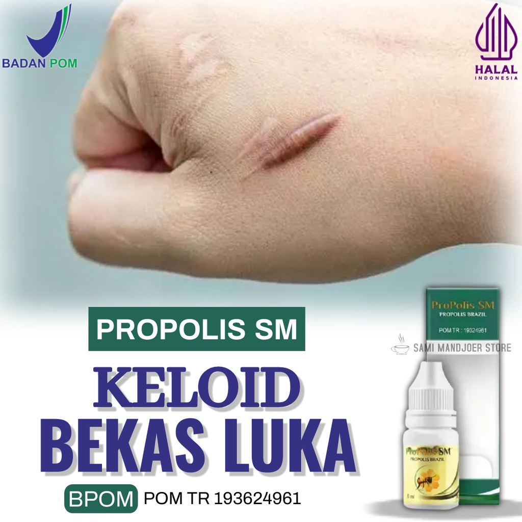 Salep Perontok Keloid, Obat Keloid, Mengempiskan Keloid Luka Yang Tumbuh Seperti Tonjolan Pada Kulit