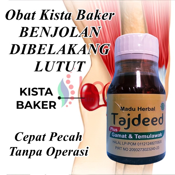 Obat Kista Baker Di Apotik | Obat Benjolan Dibelakang Sendi Lutut Tanpa Operasi | Pantangan Kista Ba