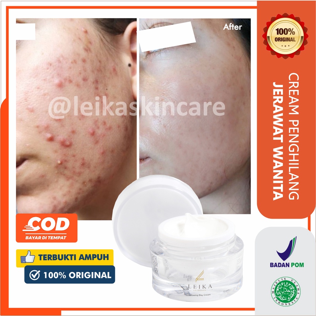 Cream Penghilang Jerawat Ampuh Sudah BPOM! Cream Penghilang Jerawat Membandel Krim Penghilang Jerawat Penghilang Bekas Jerawat Obat Jerawat &amp; Bekas Jerawat Cream Penghilang Bekas Jerawat Glowing Day Cream Leika Skincare 10gr Halal MUI Resmi BPOM