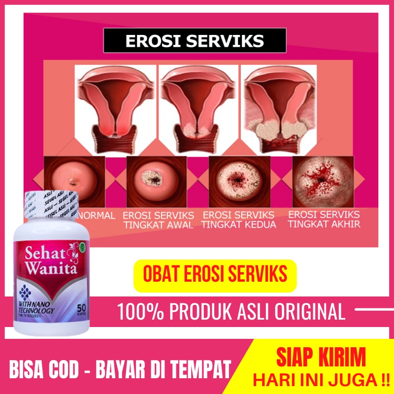 Obat Erosi Serviks, Sariawan Pada Mulut Rahim, Erosi Portio, Keputihan Berlebih, Kanker Serviks, Seh