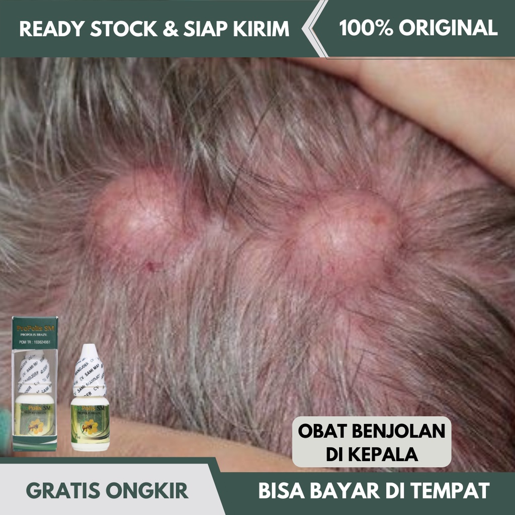 Obat Benjolan di Kepala, Obat Penghilang Benjolan di Kepala, Obat Oles Benjolan di Kepala, Bisul di 