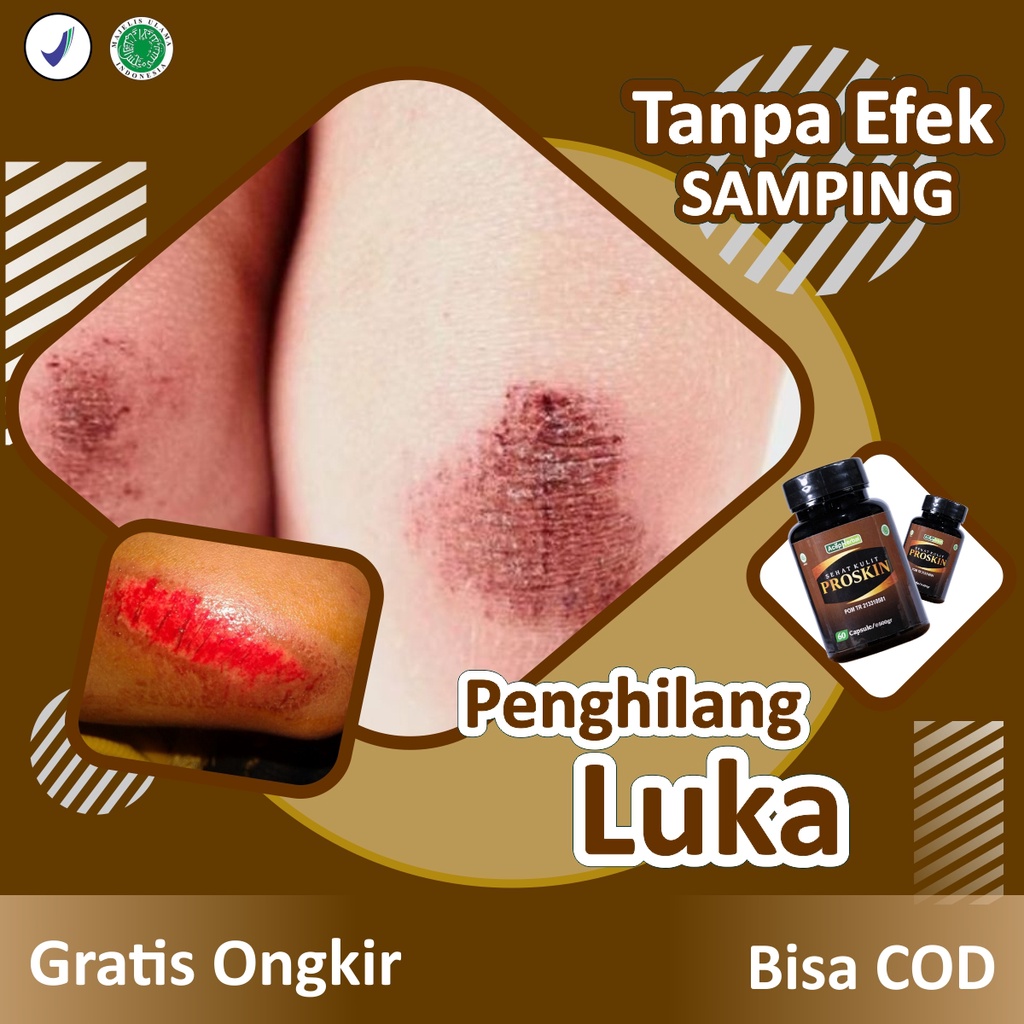 Obat Penghilang Bekas Luka Hitam Koreng Paling Alami Menghilangkan Bekas Luka Bakar Jatuh di Kaki Wa