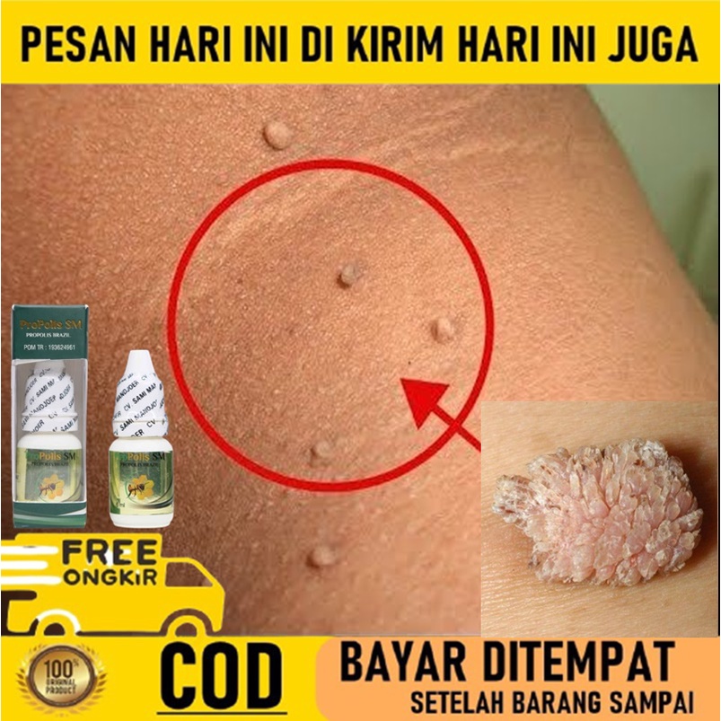 Obat Perontok kutil - Obat kutil papiloma - Perontok kutil - Obat Kutil di leher - Obat Penghilang k