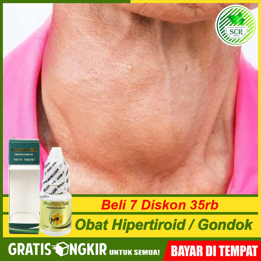 

Obat Hipertiroid Gondok Benjolan Di Leher Kelenjar Getah Bening Bengkak Propolis Di Cirebon Bisa COD