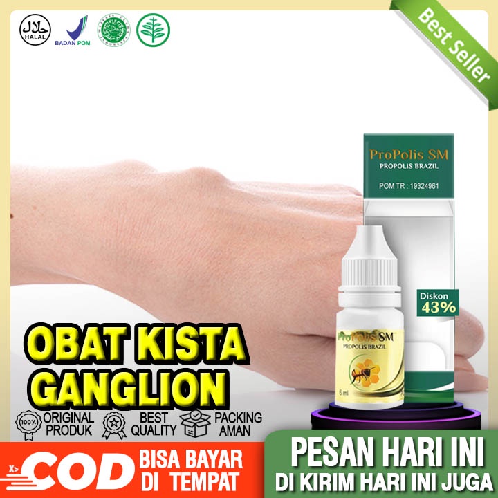 Obat Kista Ganglion - Obat Benjolan Di Tangan - Benjolan Pergelangan