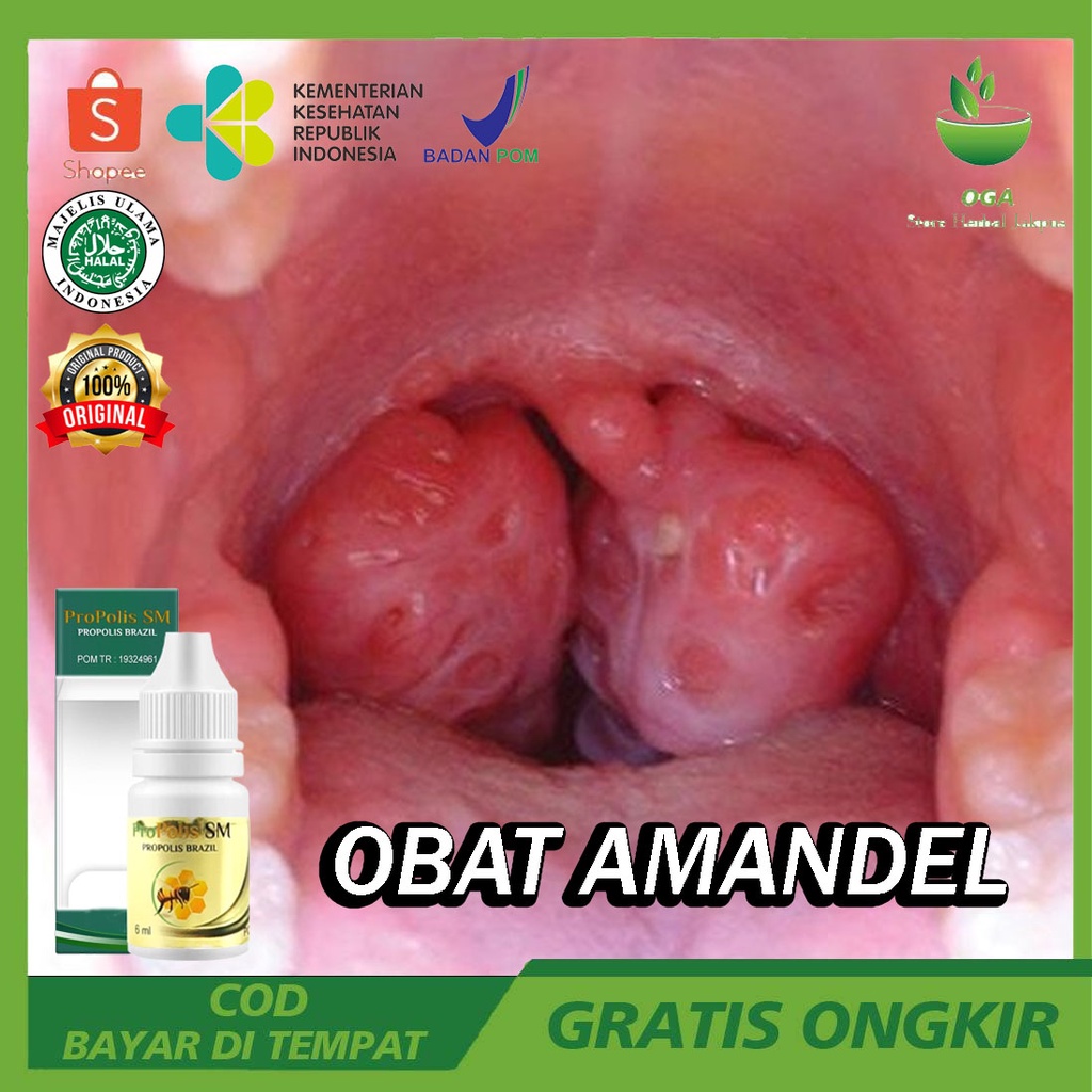 Obat Amandel Untuk Anak dan Dewasa - Amandel Bengkak - Amandel Menahun - Amandel Parah - Amandel Sak