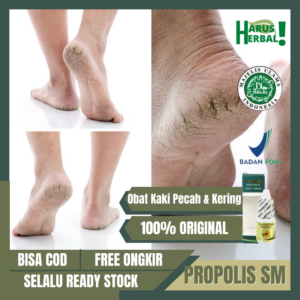 Obat Kaki Pecah Dan Kering, Obat Tumit Kaki Pecah-Pecah, Penghalus Tumit Kaki, Obat Telapak Kaki Ker