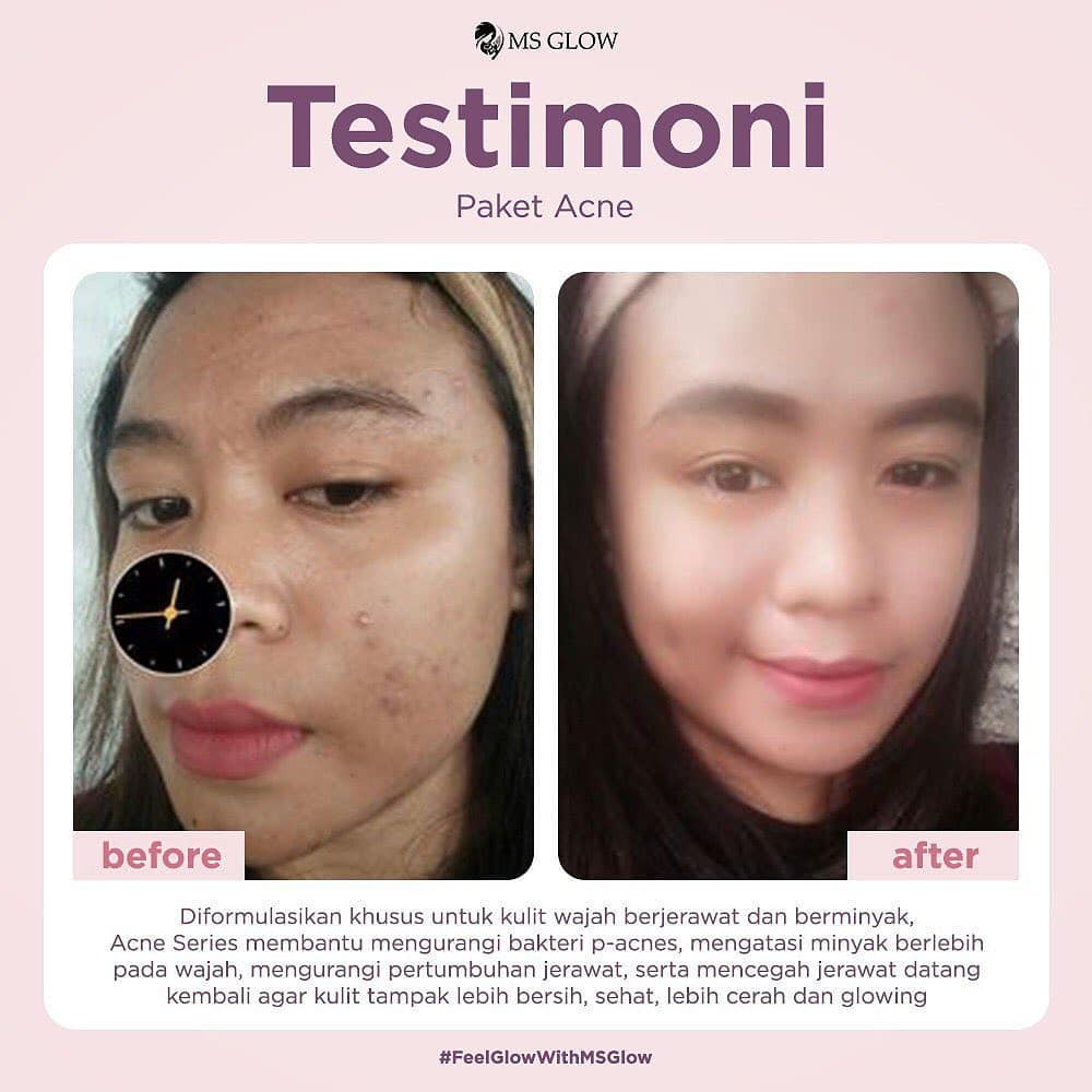 Ms Glow Paket Luminous - Paket Perawatan Wajah Wanita Mencerahkan Kulit Menghilangkan Bekas Jerawat-5