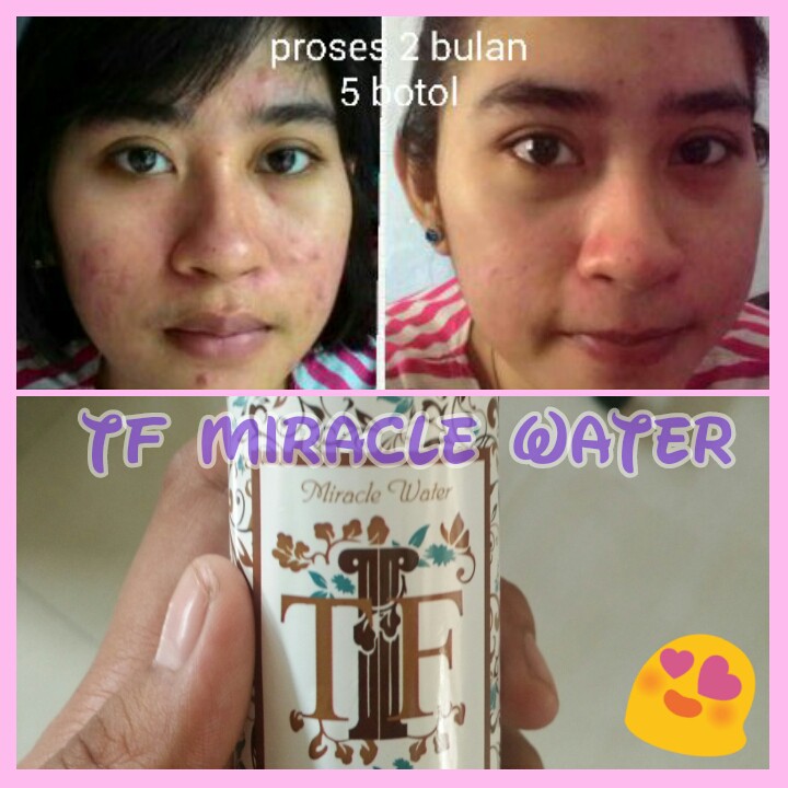 Obat Jerawat Alami Organik