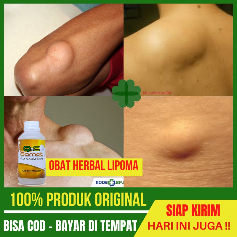 Obat Lipoma, Penghilang Benjolan Lipoma, Penghancur Lipoma di Kepala di Pundak di Jidat dan Dada, Ob