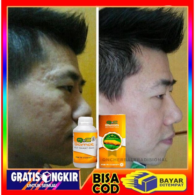 Obat Bopeng Bekas Jerawat, Penghilang Noda Hitam Wajah, Jerawat, Masker Wajah Alami