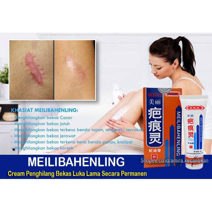 Obat Penghilang Bekas Luka Permanen Meilibahenling Cream Penghilang Bekas Luka Alami Shopee Indonesia