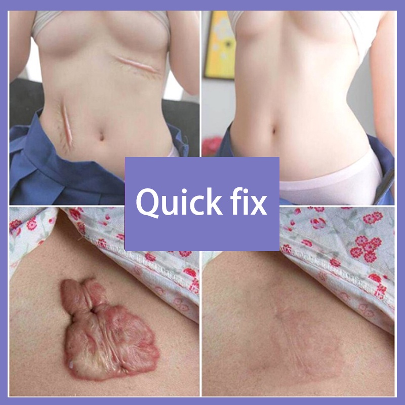 Penghilang bekas luka Acne Cream Scar Removal Penghilang Noda Bekas Jerawat 30g+30g Luka &amp; Stretch Mark scar cream