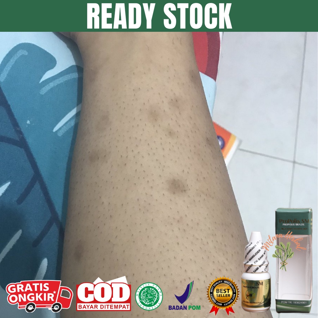 obat penghilang bekas luka koreng hitam, penghilang bekas luka koreng, penghilang bekas koreng lama 