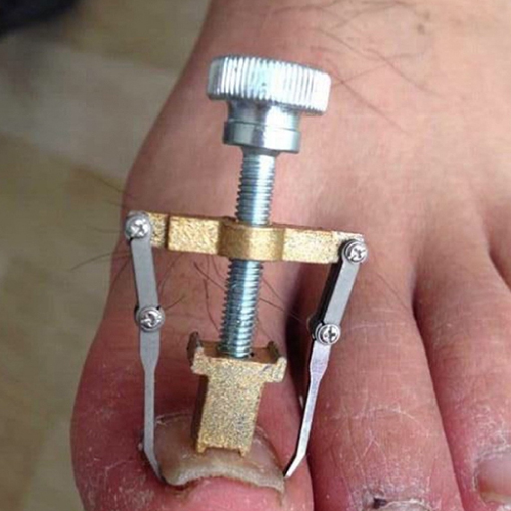 (LIKE) Alat Koreksi Kuku Kaki Tumbuh Kedalam Profesional Untuk Pedicure