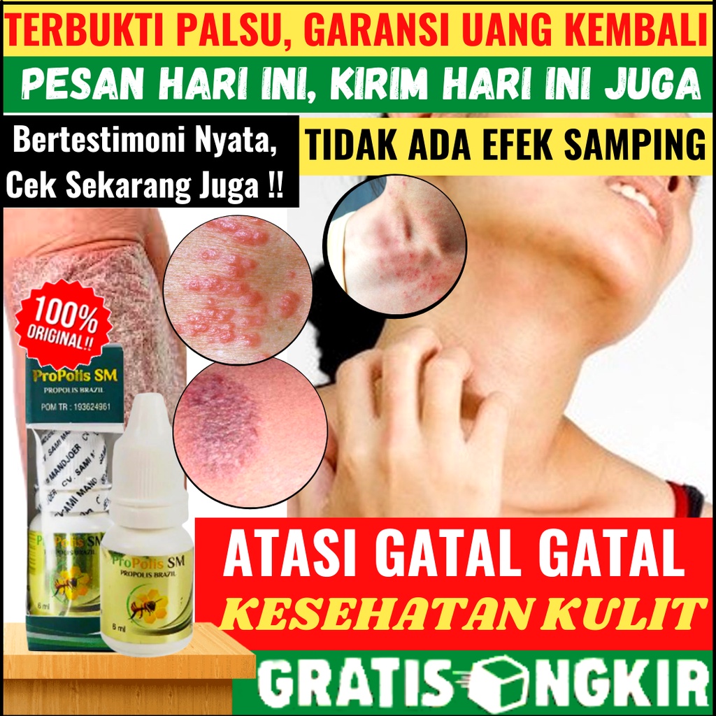Obat Gatel Kulit Parah, Infeksi Koreng, Jamur, Panu, Gatal Eksim untuk Dewasa dan Anak, Borok Bersis
