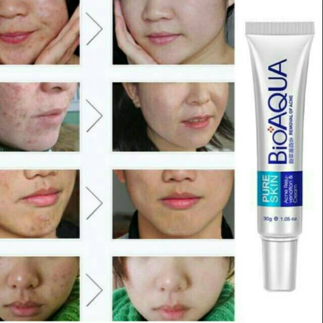 Cream Jerawat Pure Skin Bioaqua Shopee Indonesia