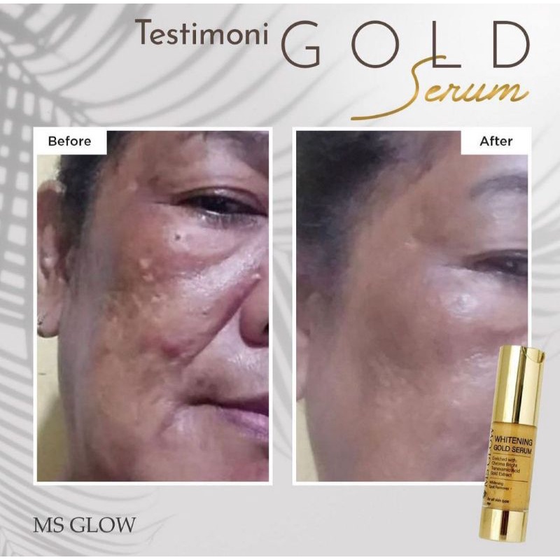 SERUM MS GLOW / SERUM LUMINOUS MS GLOW / SERUM LIFTHING MS GLOW / SERUM ACNE / GOLD SERUM WAJAH