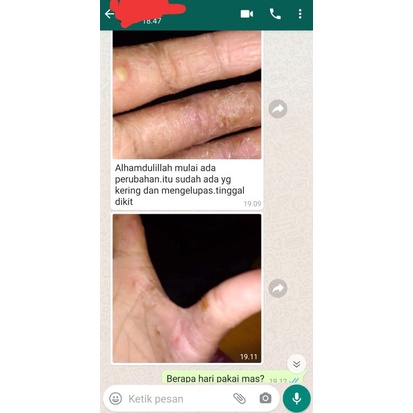 Salep BL Ampuh ASLI Original 100% | Obat Gatal | Salep Kulit Gatal | Obat Eksim Exim