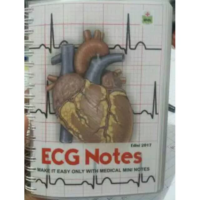 MMN ECG (MMN EKG)