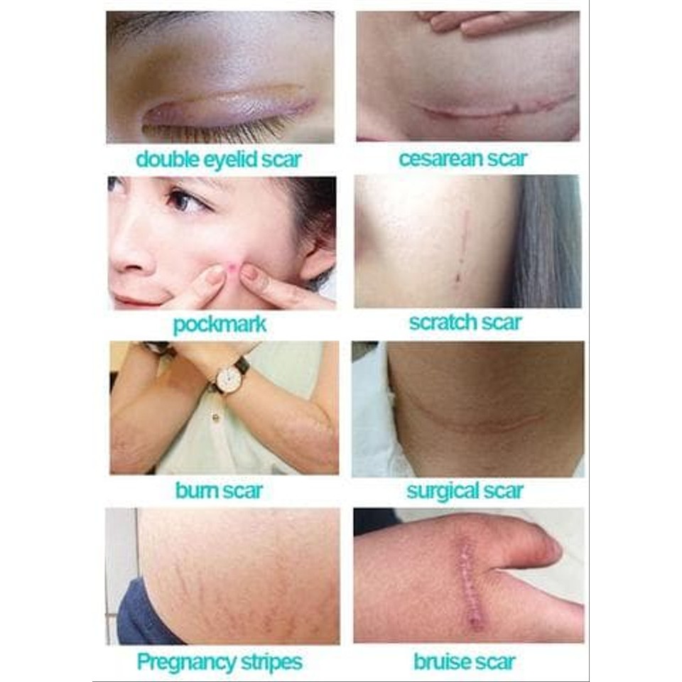 OBAT PENGHILANG LUKA SCAR REMOVAL SILICONE PATCH TRETCH MARK