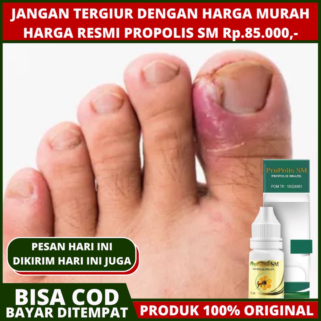 Jual Obat Cantengan Sakit Kuku Jari Jempol Kaki Tangan Bengkak