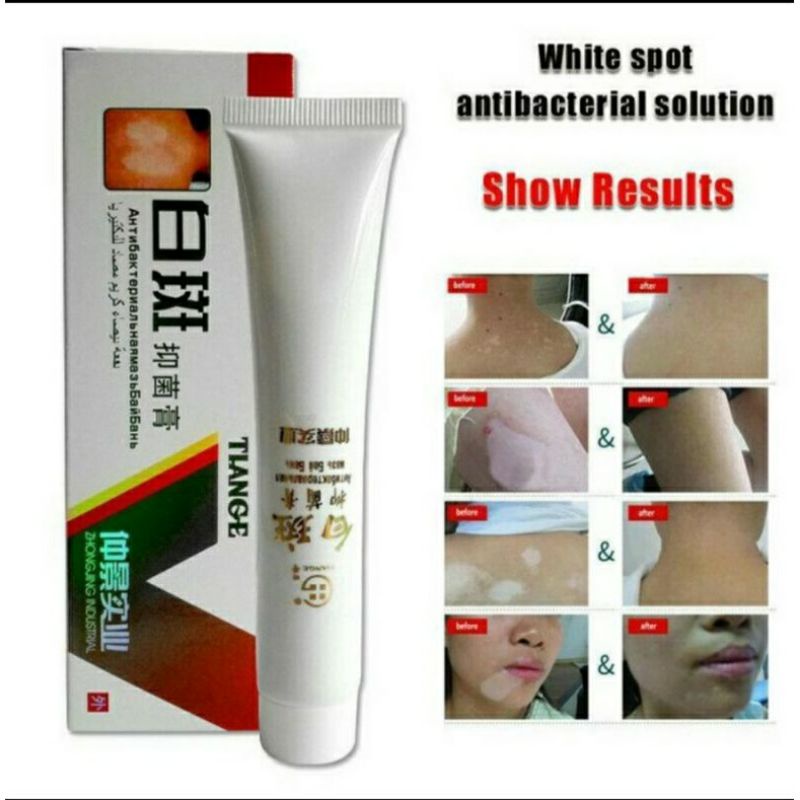 Obat Penyakit Kulit Vitiligo Salep Cream Untuk Belang Putih Dikulit