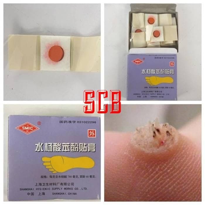 PLASTER KUTIL / PLESTER KUTIL / OBAT KUTIL / MATA IKAN / KAPALAN / JI YAN GAO ORIGINAL