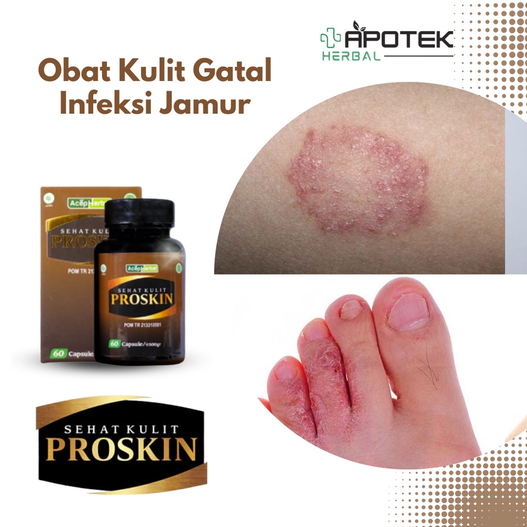 Obat Kulit Gatal Infeksi Jamur, Obat Gatal Selangkangan, Obat Gatal Kelamin, Gatal Eksim, Obat Gatal