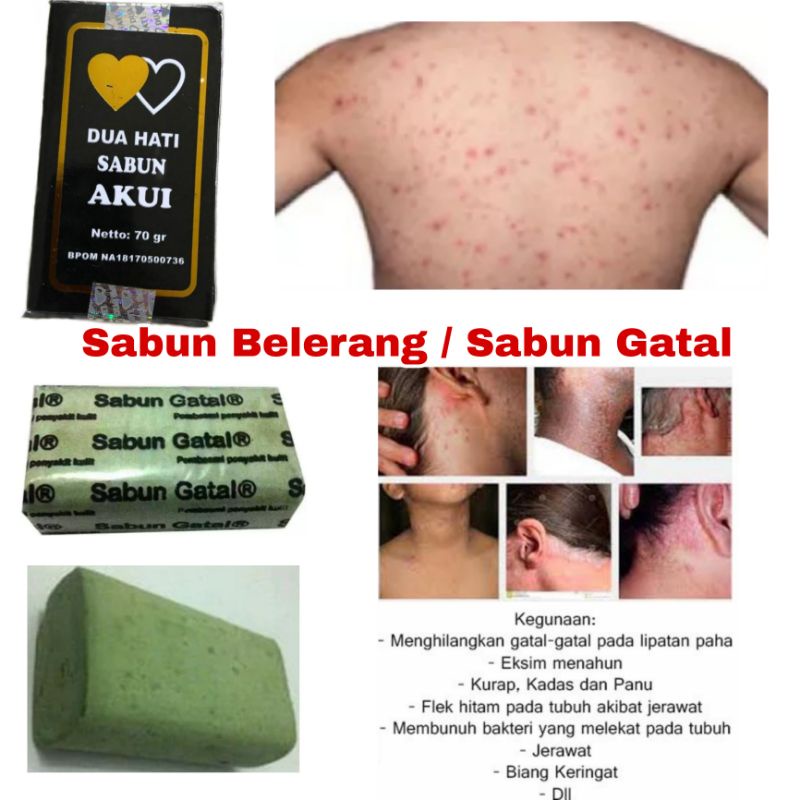 Sabun Sulfur BPOM / Sabun Belerang / Sabun Gatal / Sabun Akui / Sabun Dua Hati Atasi Gatal, Eksim, Kadas, Kurap, Panu, Flek Hitam &amp; Membunuh Bakteri / Sabun Anti Gatal / Sabun Menghilangkan Flek Hitam / Sabun Eksim / Sabun Panu / Sabun Kurap / Sabun Kadas