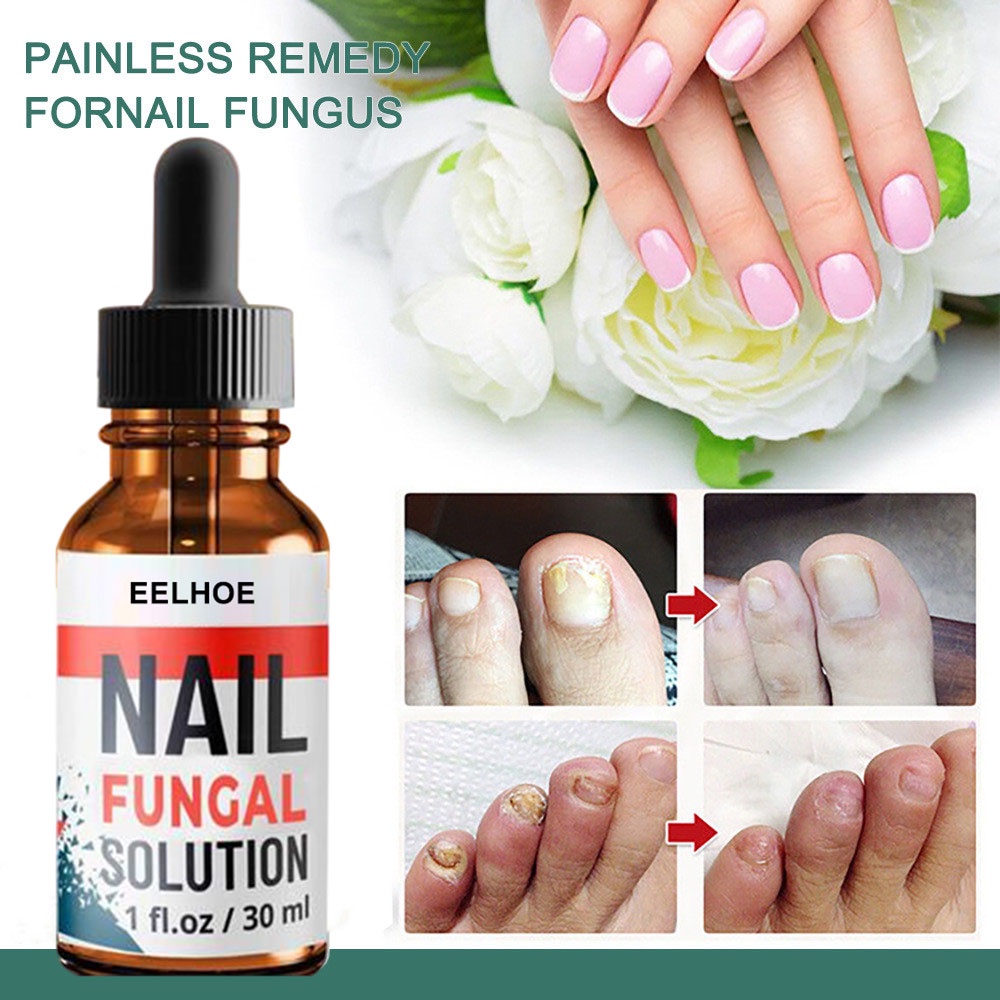 EELHOE Obat Jamur Kuku Jamur Kulit Pemutih Kuku Penghilang Gel Nail Treatment Serum -30ml