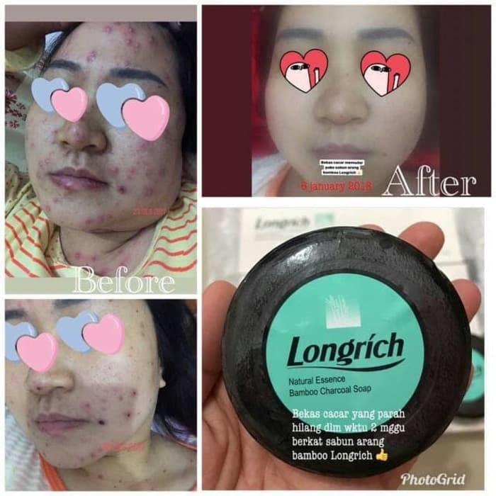 sabun arang bambu longrich penghilang jerawat alergi masalah kulit